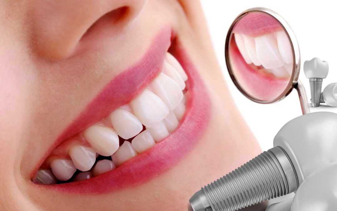 Problemas y soluciones de las prótesis dentales fijas sobre implantes