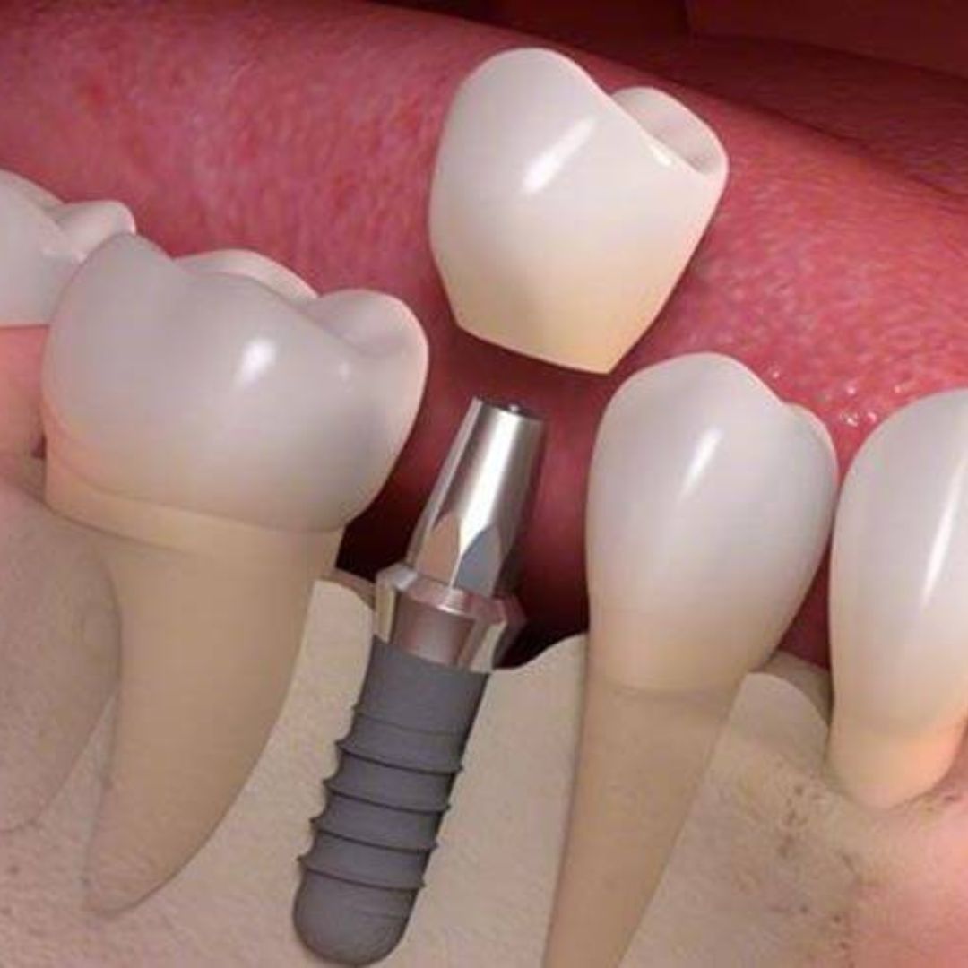 Implantes
