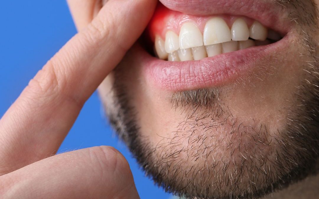 «Periodontitis: Comprendiendo la Enfermedad Silenciosa que Amenaza la Salud Bucal y Sistémica»