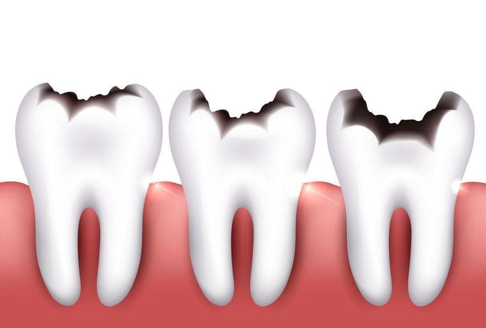 Caries Dentales: Definición, Clasificación y Comprensión de su Impacto en la Salud Oral