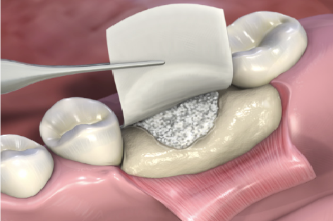 Membrana 1