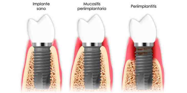 La Periimplantitis: Etiología, Diagnóstico y Opciones Terapéuticas