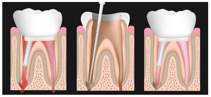 Retratamiento de Endodoncia.