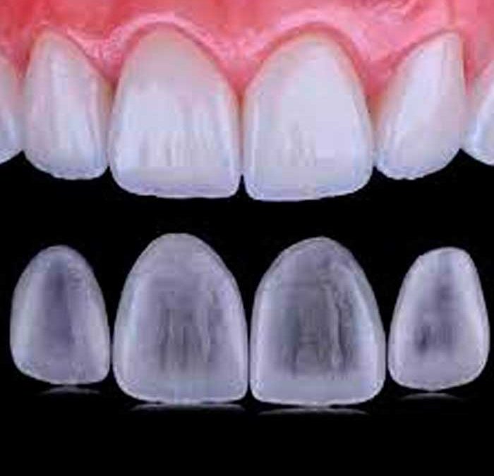 Carillas y lentes cerámicos en odontología y su relación con la implantología dental