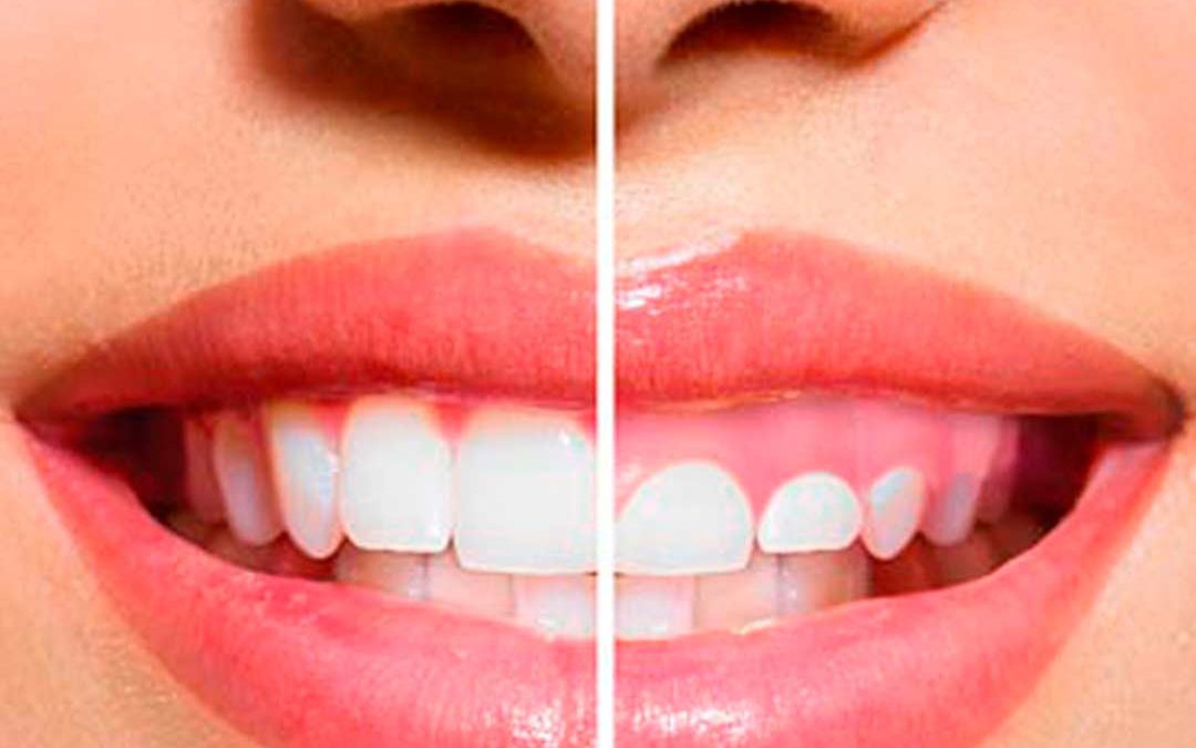 La Gingivectomía: Técnica, Beneficios y Complicaciones de una Cirugía Clave en la Salud Bucal