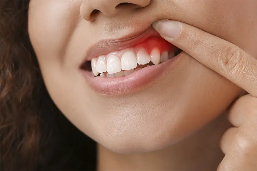 gingivitis-causas-sintomas-tratamientos
