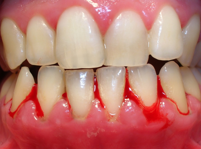Gingivitis: Tratamiento Odontológico