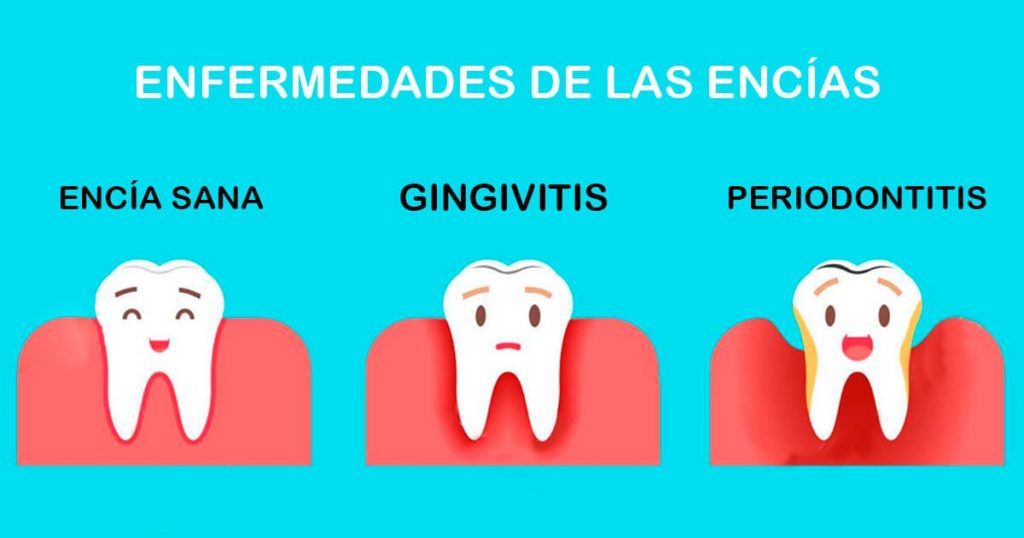La Gingivitis: Etiología, Manifestaciones Clínicas y Abordaje Terapéutico