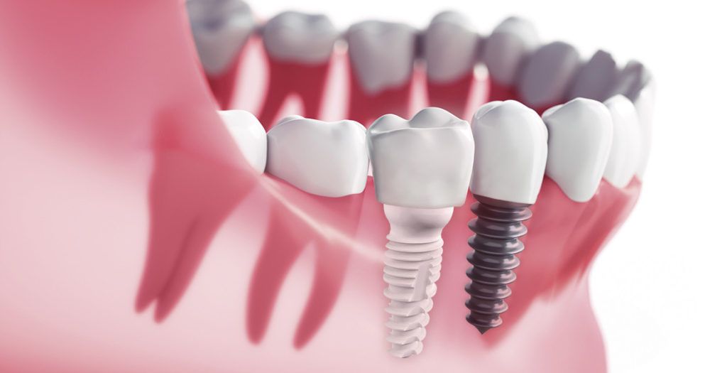 implantes-zirconio