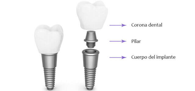 partes-de-un-implante-dental