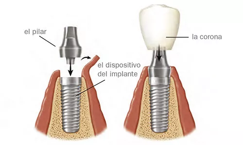Implantes Dentales: Definición y Partes de la Implantología Dental