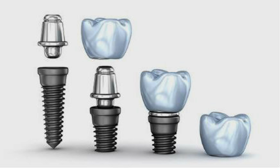 Tipos de Implantes Dentales: Clasificación y Características